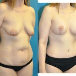 Mommy Makeover #22 - Before and After