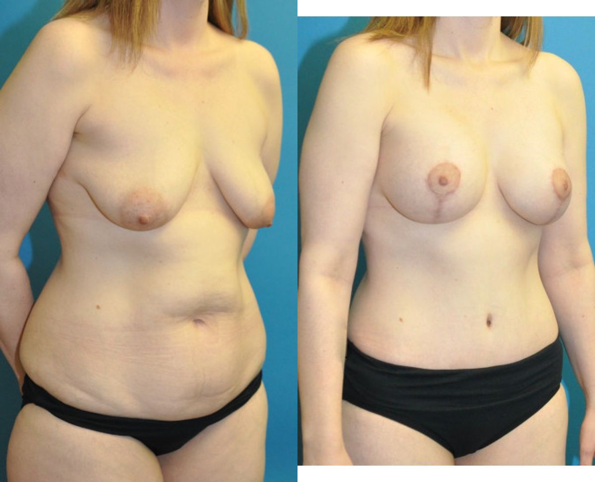 Mommy Makeover #22 - Before and After