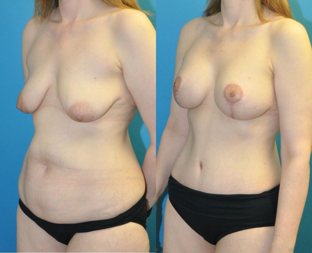 Mommy Makeover #22 - Before and After