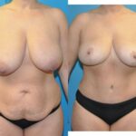 Mommy Makeover #24 - Before and After