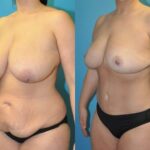 Mommy Makeover #24 - Before and After