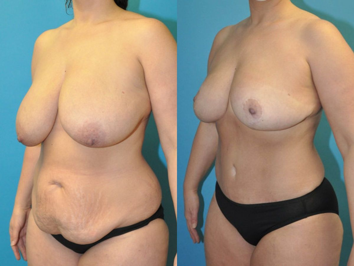 Mommy Makeover #24 - Before and After