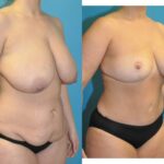 Mommy Makeover #24 - Before and After