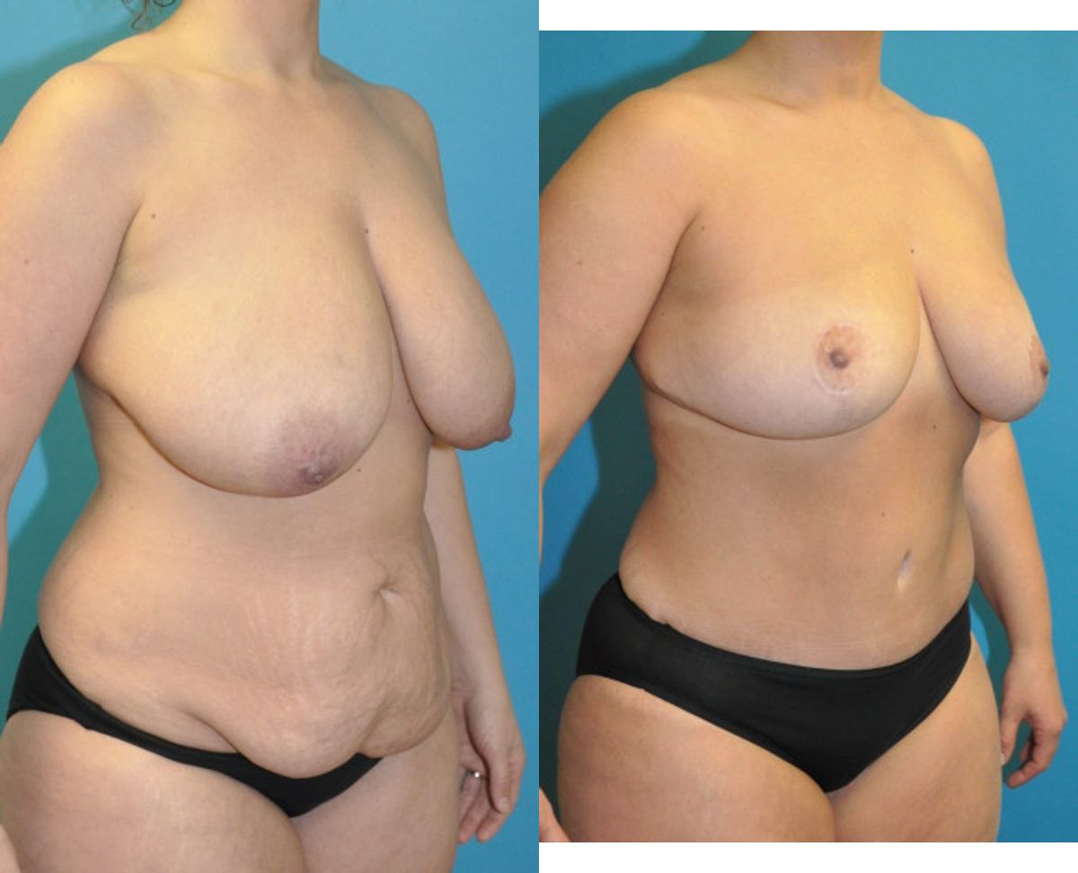 Mommy Makeover #24 - Before and After