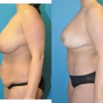 Mommy Makeover #24 - Before and After