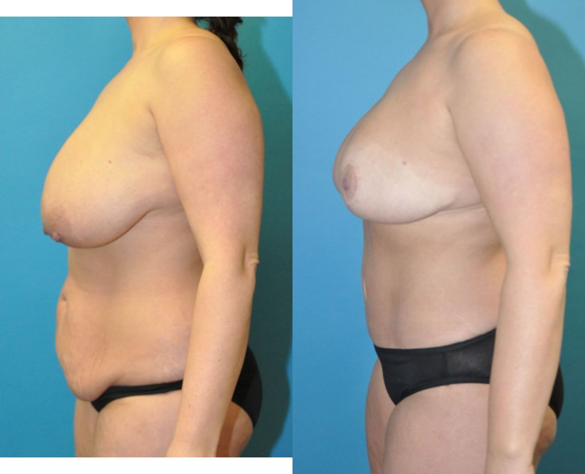 Mommy Makeover #24 - Before and After