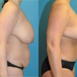 Mommy Makeover #24 - Before and After