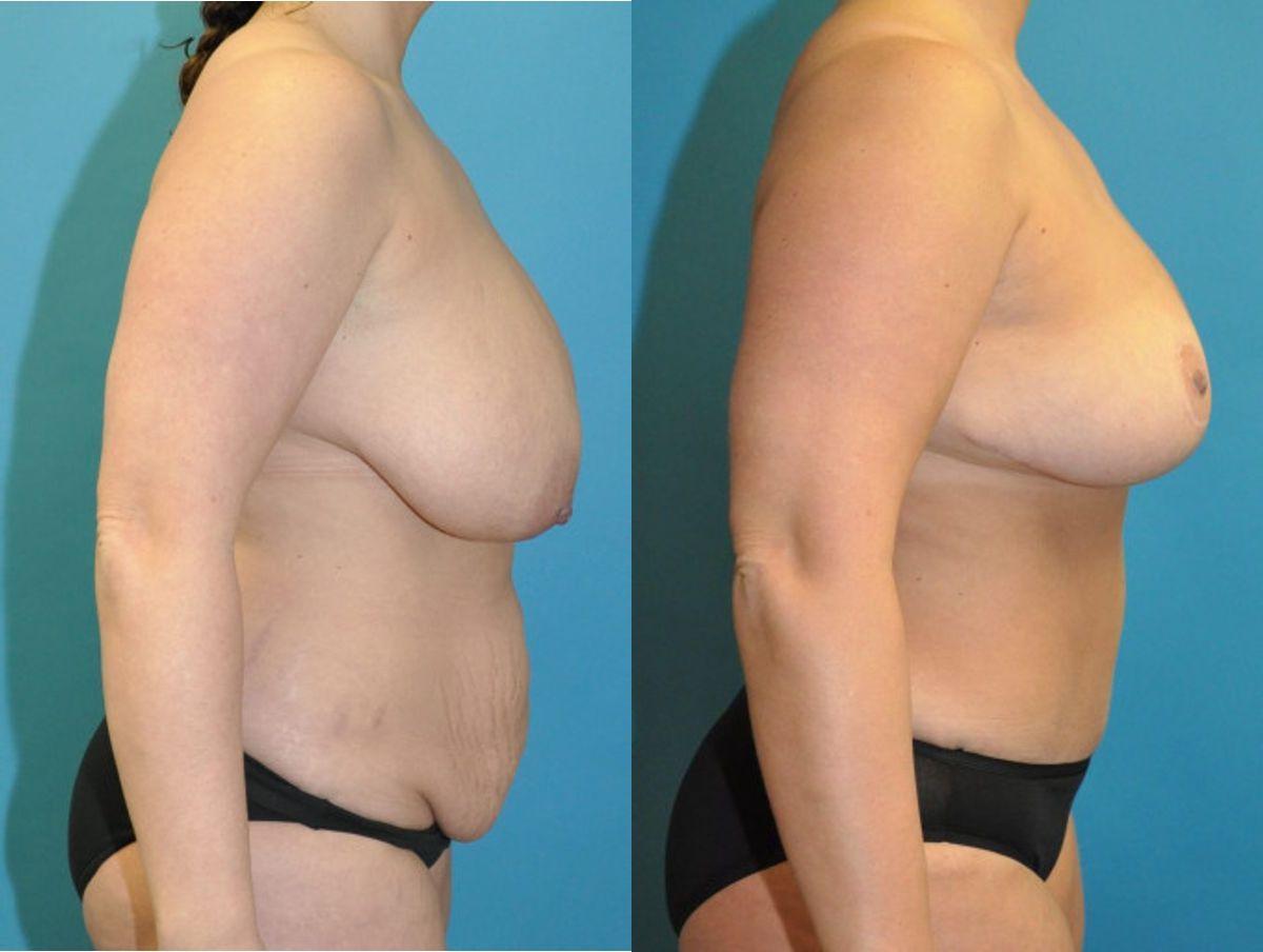 Mommy Makeover #24 - Before and After