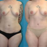 Mommy Makeover #25 - Before and After