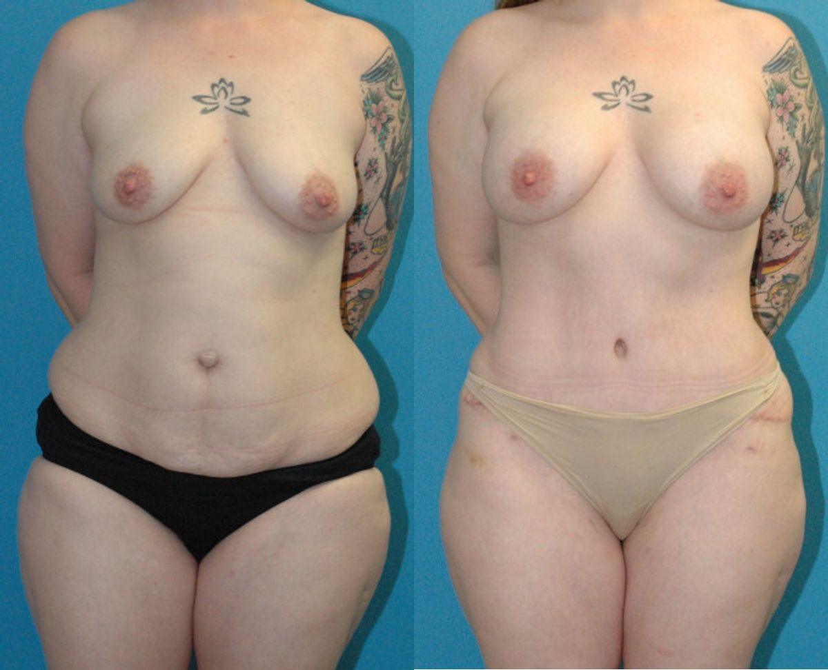 Mommy Makeover #25 - Before and After