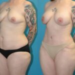 Mommy Makeover #25 - Before and After