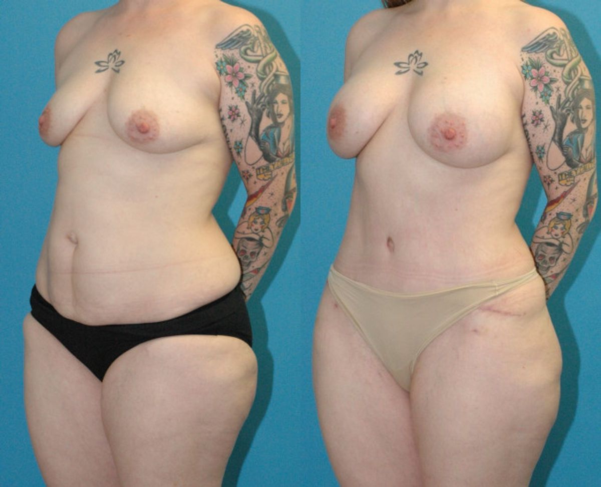 Mommy Makeover #25 - Before and After