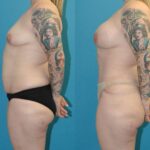 Mommy Makeover #25 - Before and After