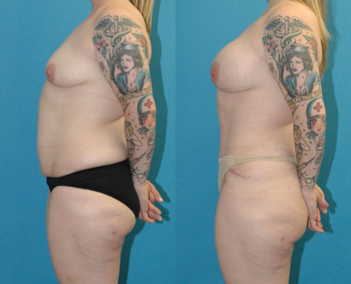 Mommy Makeover #25 - Before and After