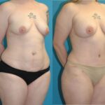 Mommy Makeover #25 - Before and After