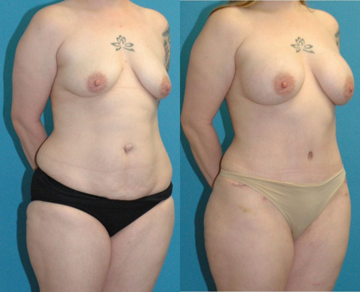 Mommy Makeover #25 - Before and After