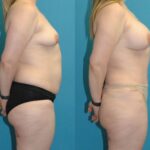 Mommy Makeover #25 - Before and After