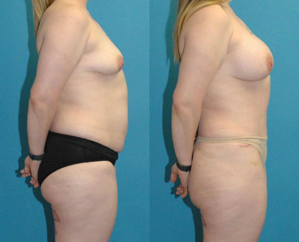 Mommy Makeover #25 - Before and After