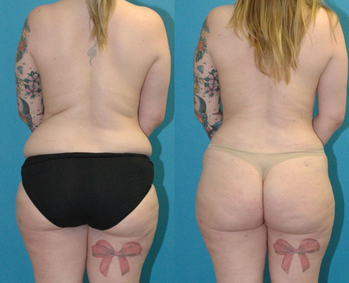 Mommy Makeover #25 - Before and After