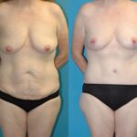 Mommy Makeover #26 - Before and After