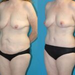 Mommy Makeover #26 - Before and After