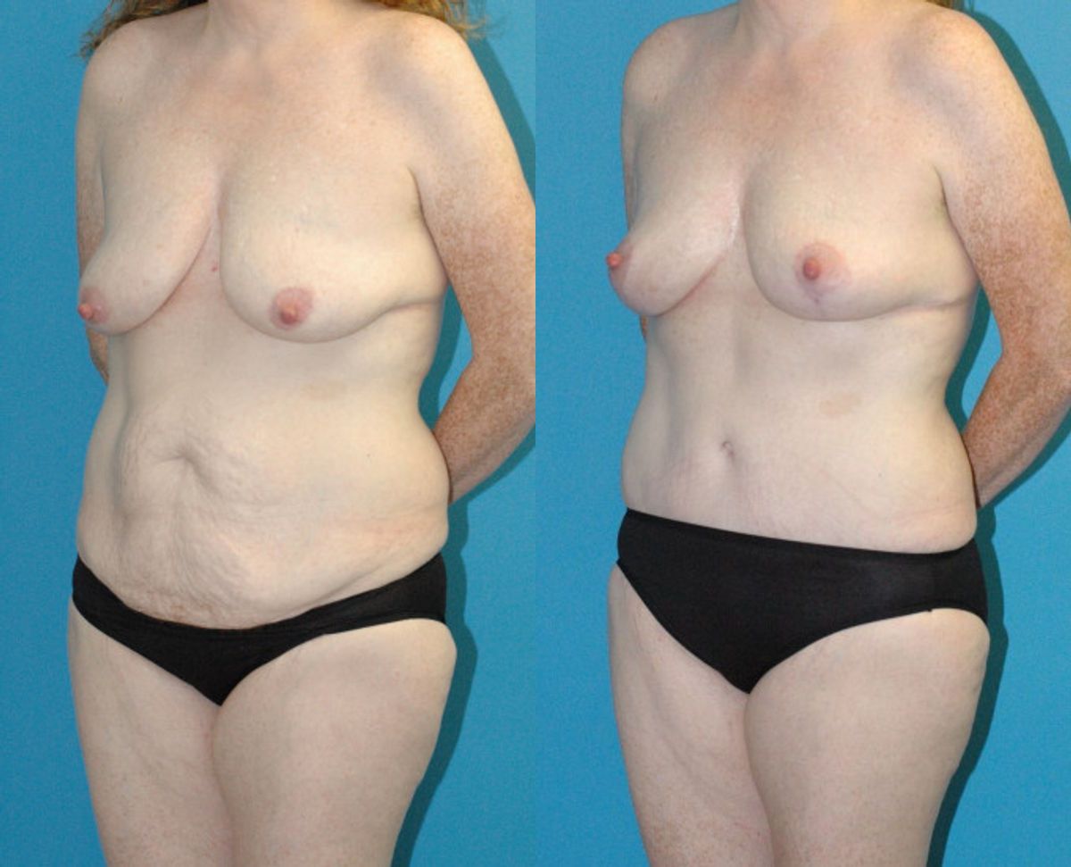 Mommy Makeover #26 - Before and After