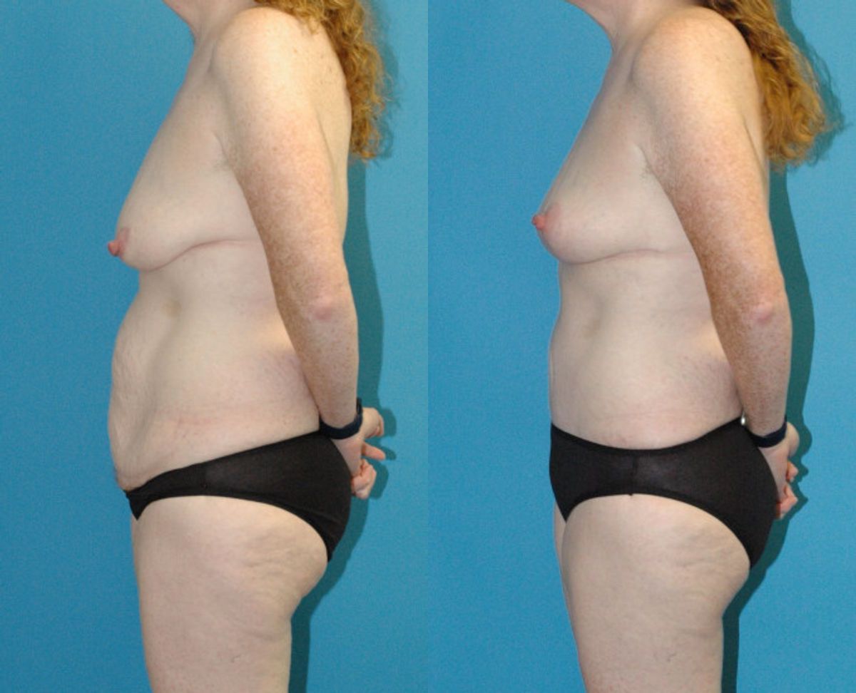 Mommy Makeover #26 - Before and After