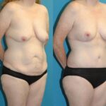 Mommy Makeover #26 - Before and After