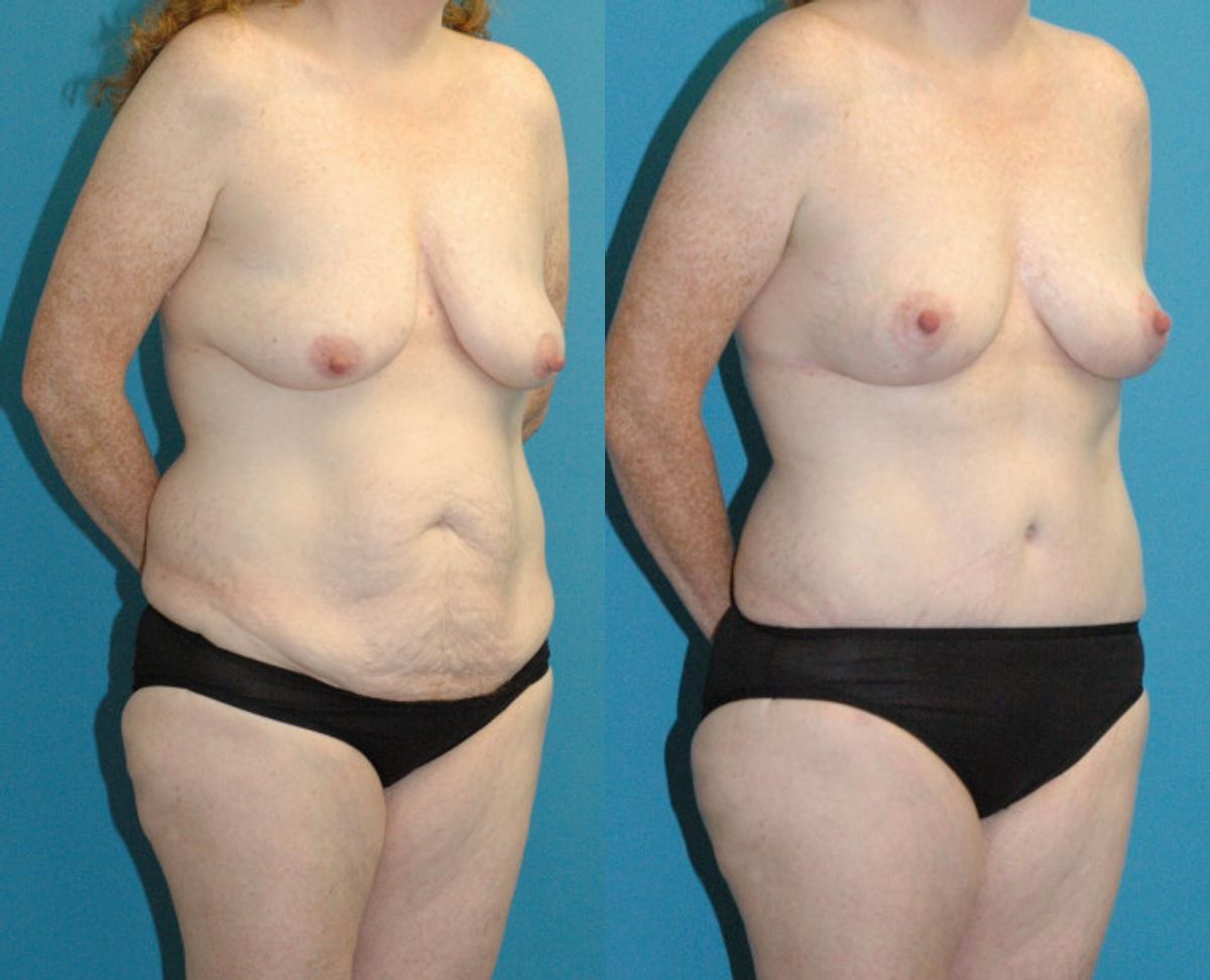 Mommy Makeover #26 - Before and After