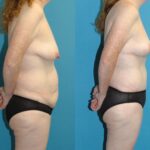 Mommy Makeover #26 - Before and After