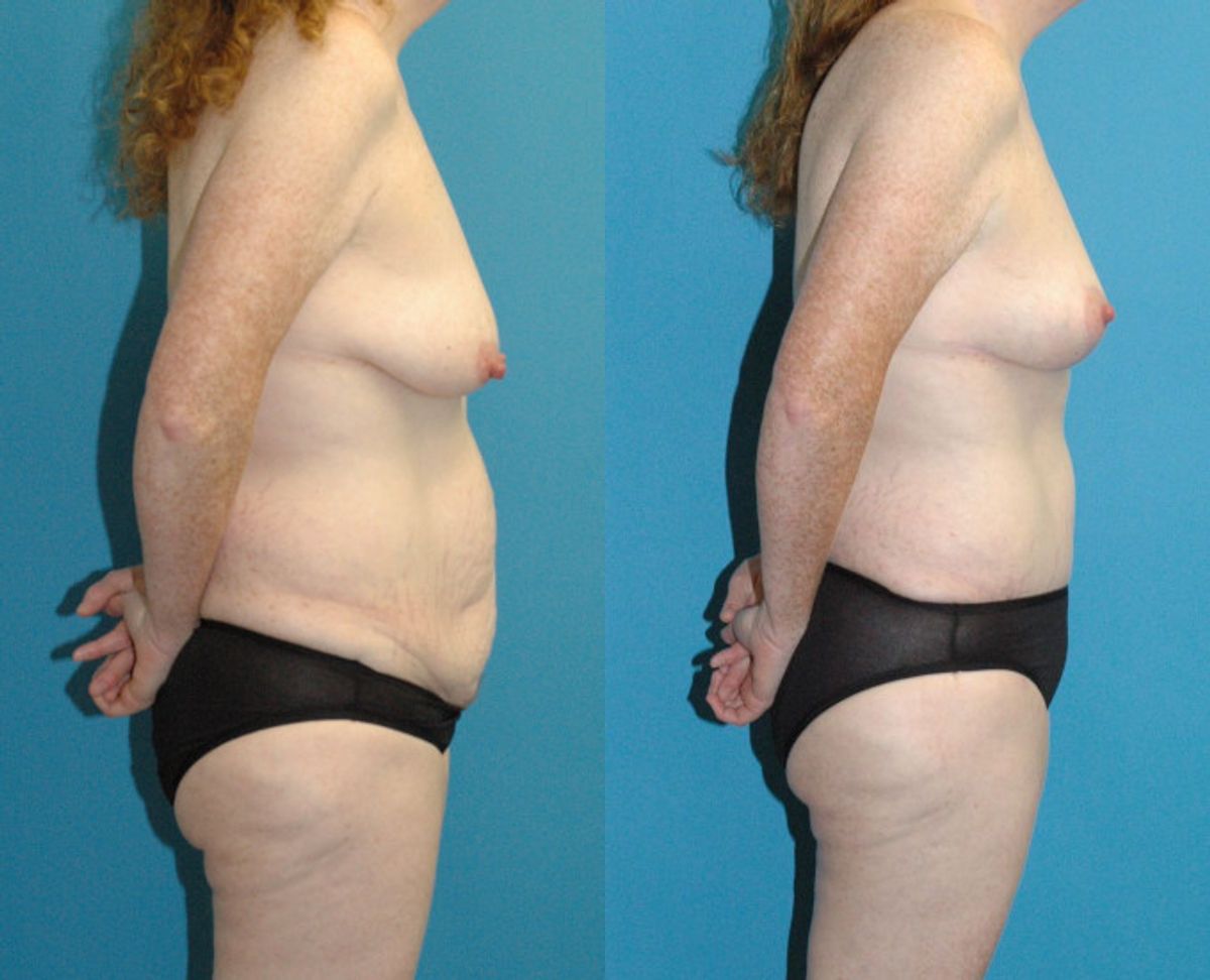 Mommy Makeover #26 - Before and After