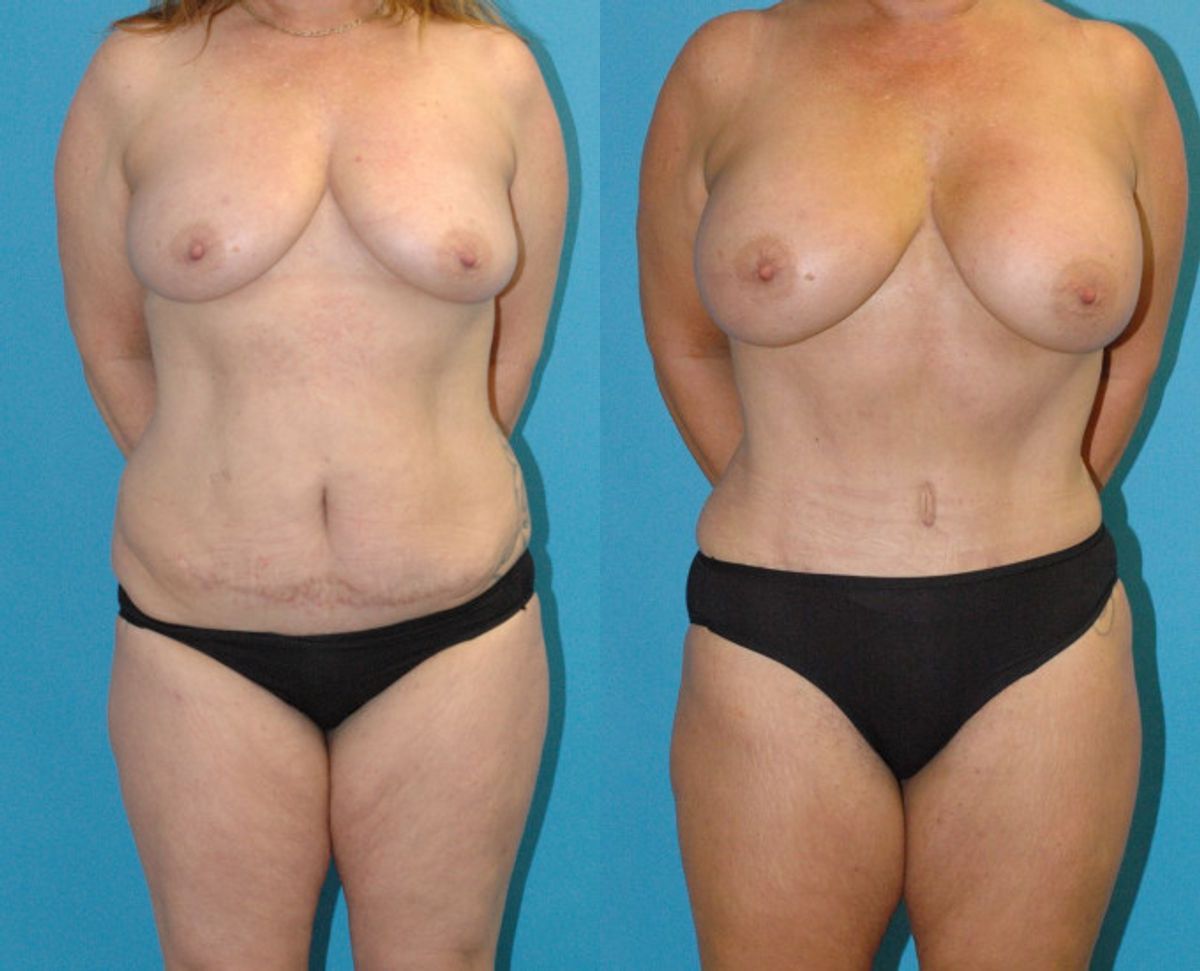 Mommy Makeover #27 - Before and After