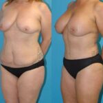 Mommy Makeover #27 - Before and After