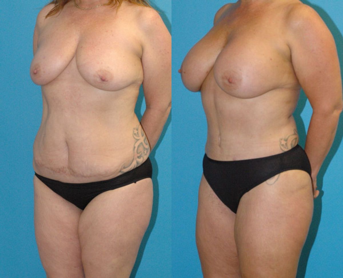 Mommy Makeover #27 - Before and After