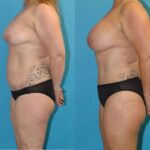 Mommy Makeover #27 - Before and After