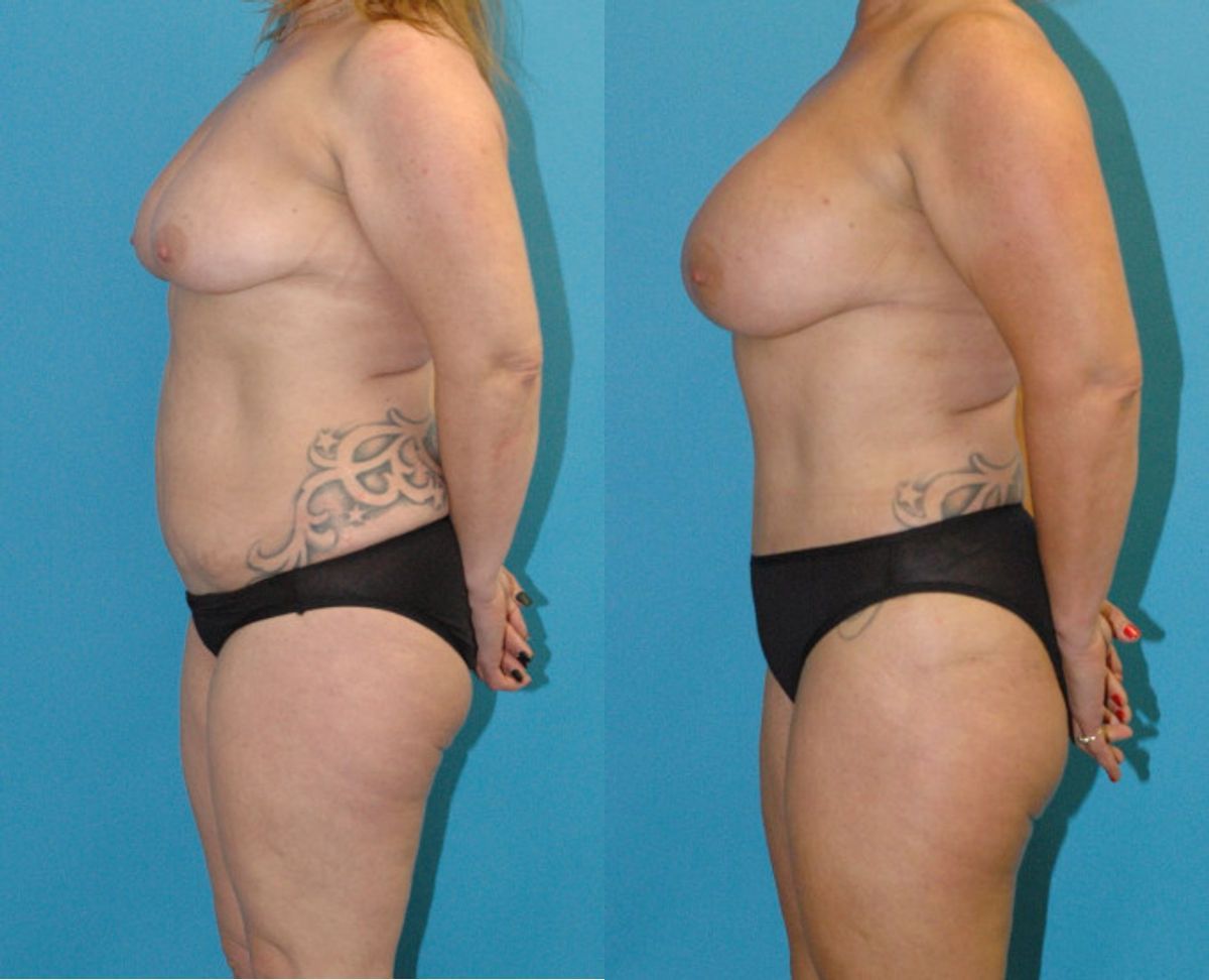 Mommy Makeover #27 - Before and After