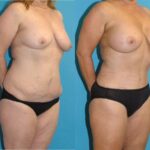 Mommy Makeover #27 - Before and After