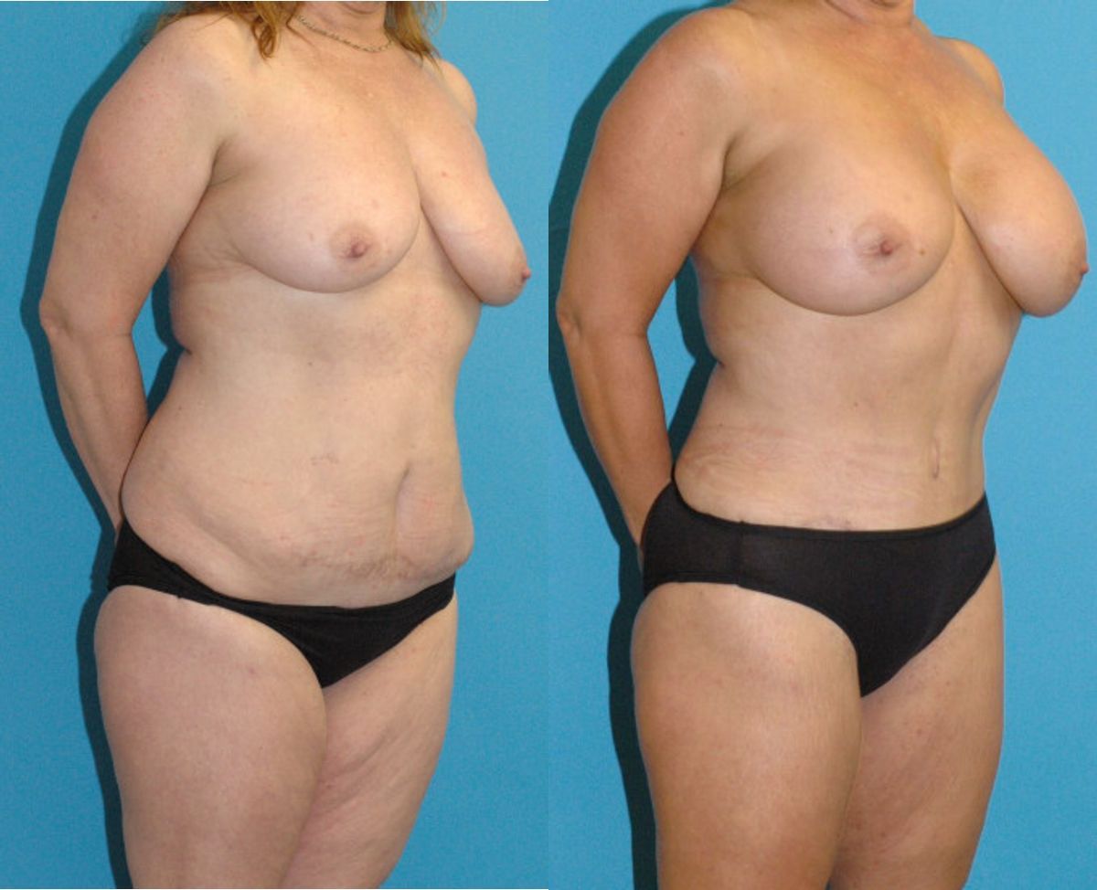 Mommy Makeover #27 - Before and After