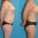 Mommy Makeover #27 - Before and After