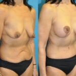 Mommy Makeover #28 - Before and After