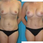 Mommy Makeover #29 - Before and After