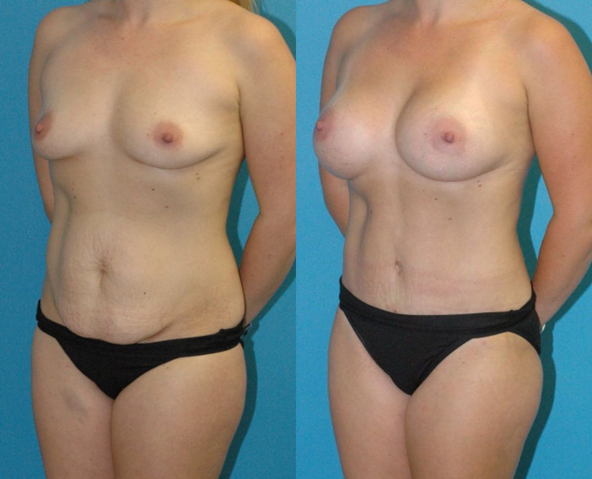 Mommy Makeover #29 - Before and After