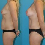 Mommy Makeover #29 - Before and After