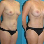 Mommy Makeover #29 - Before and After