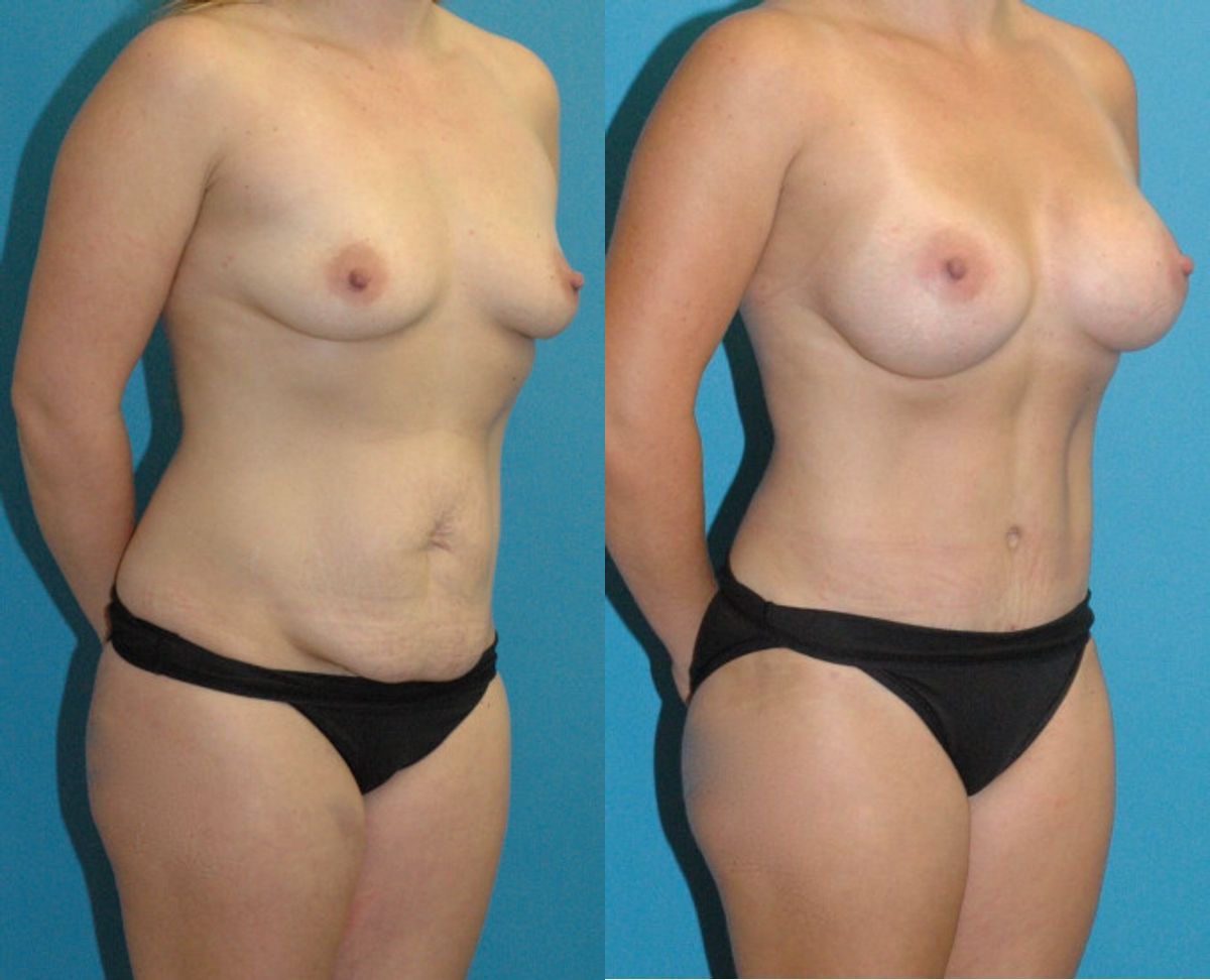 Mommy Makeover #29 - Before and After