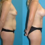 Mommy Makeover #29 - Before and After