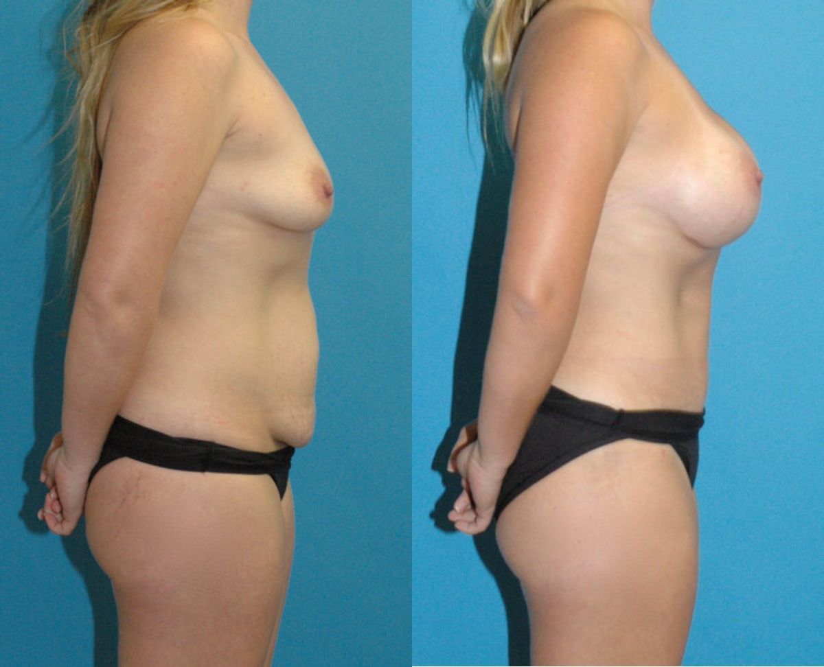 Mommy Makeover #29 - Before and After