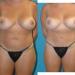 Mommy Makeover #30 - Before and After