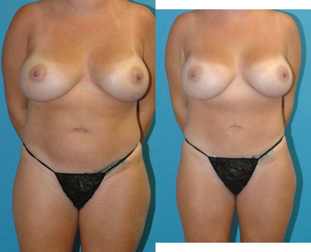 Mommy Makeover #30 - Before and After