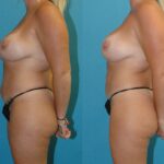 Mommy Makeover #30 - Before and After